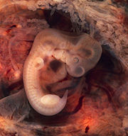180px-Tubal_Pregnancy_with_embryo.jpg