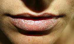 labios_resecos.jpg