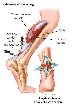 achilles_tendon_rupture.jpg