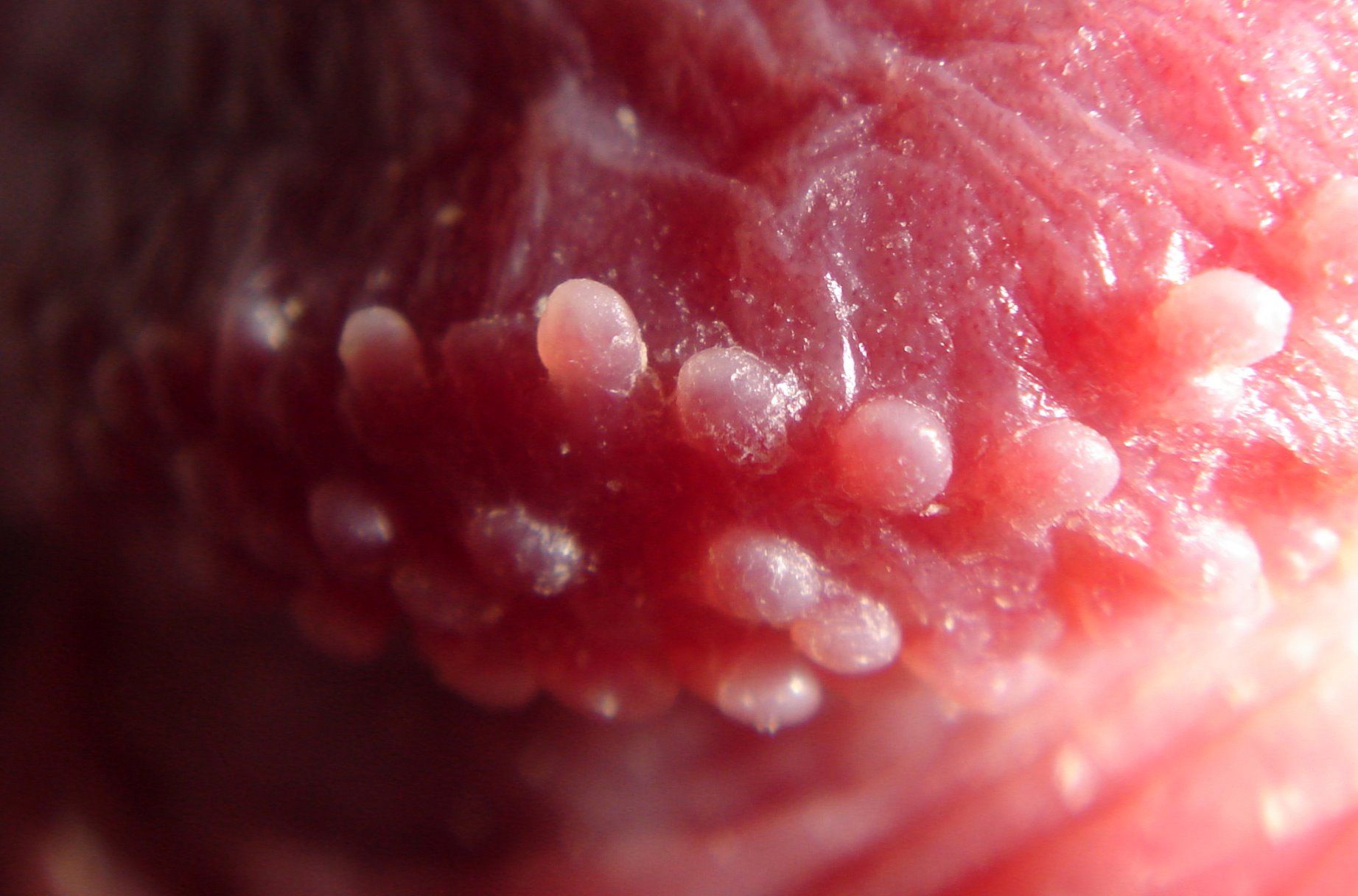 Hirsuties_papillaris_coronae_glandis_macro.jpg