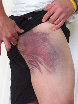 salbruise1.jpg