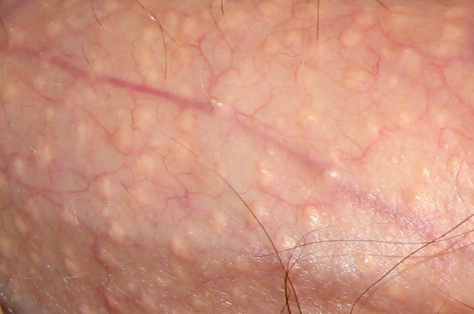 Fordyces_spot_closeup.jpg
